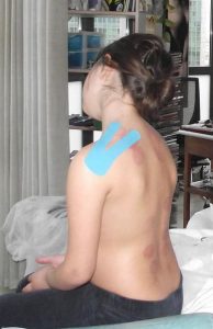 Tratamiento de la espalda con kinesiotaping